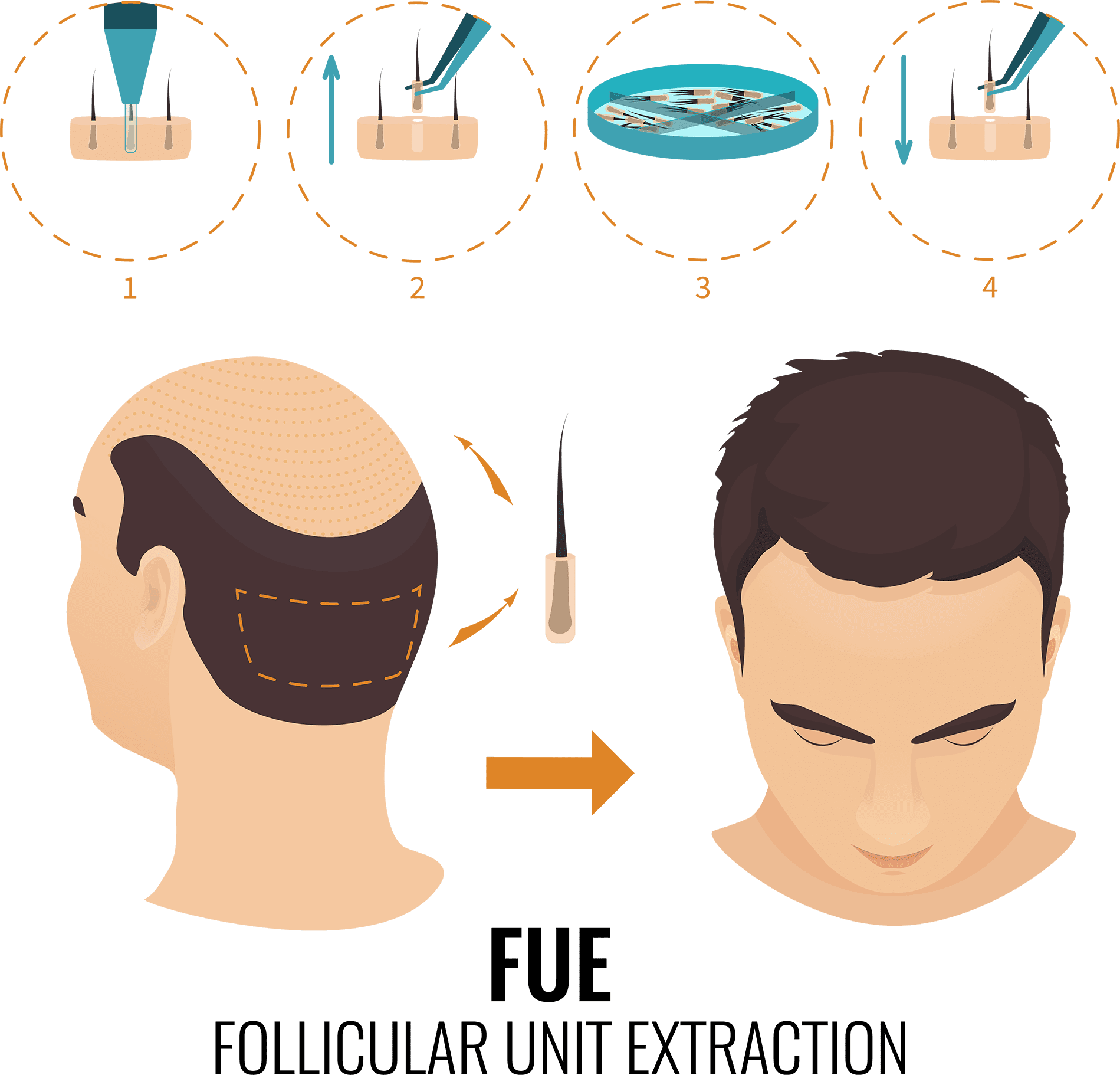 FUE Hair Transplant process