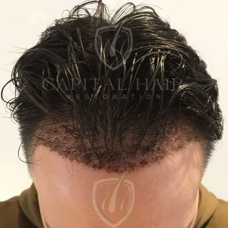FUE hair transplant results day 7