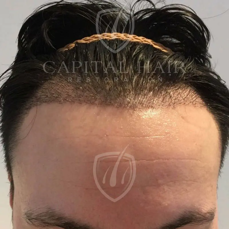 FUE hair transplant results day 15