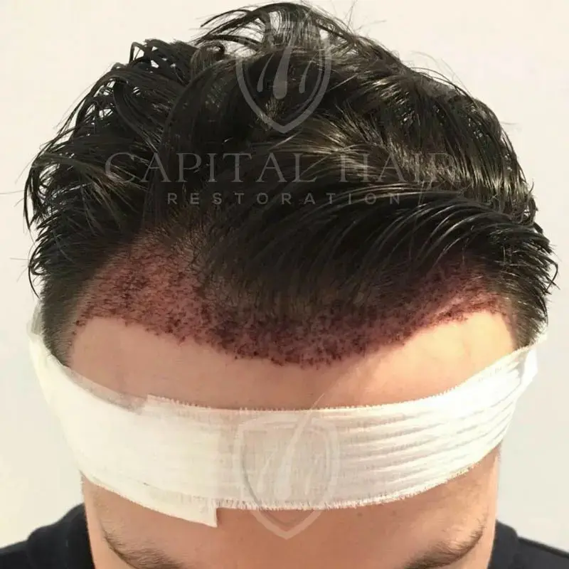fut hair transplant results day 2
