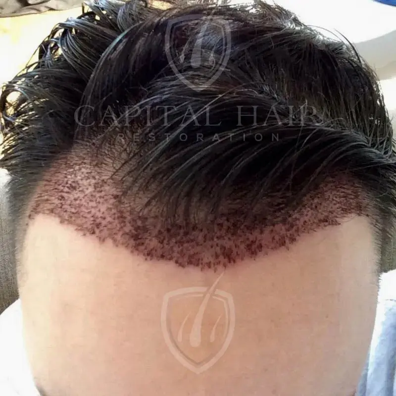 fut hair transplant results day 3