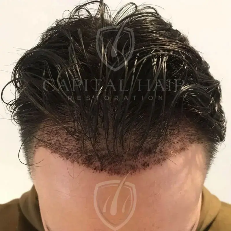 fut hair transplant results day 7