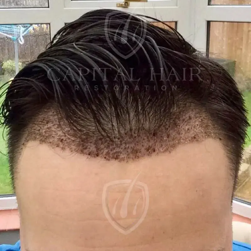 fut hair transplant results day 9