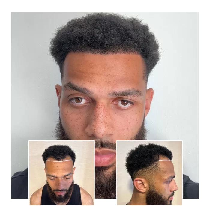Afro hair transplant patient before and after images. Central close-up shows dense, natural hairline and curls. Inset images show pre-transplant hairline markings from front and side views.