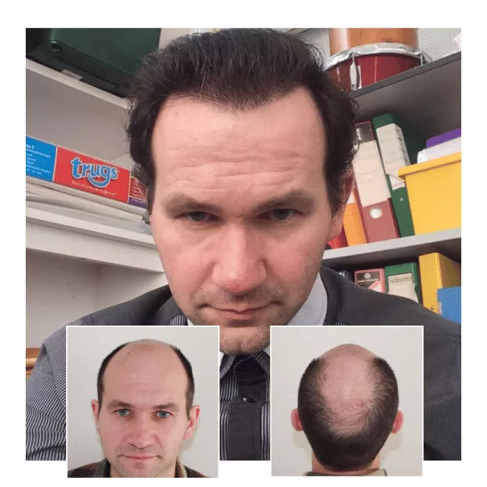Before After Hair Transplant