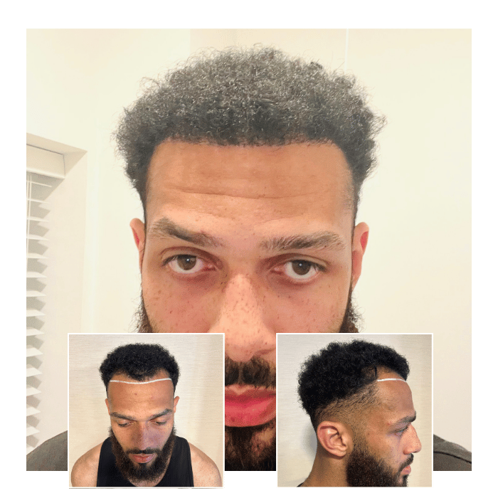 Before After Hair Transplant Manchester 06