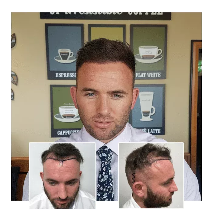 before after hair transplant birmingham 05