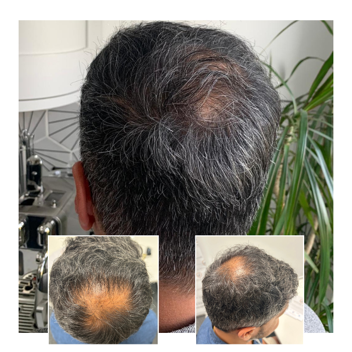 before after hair transplant portsmouth 03