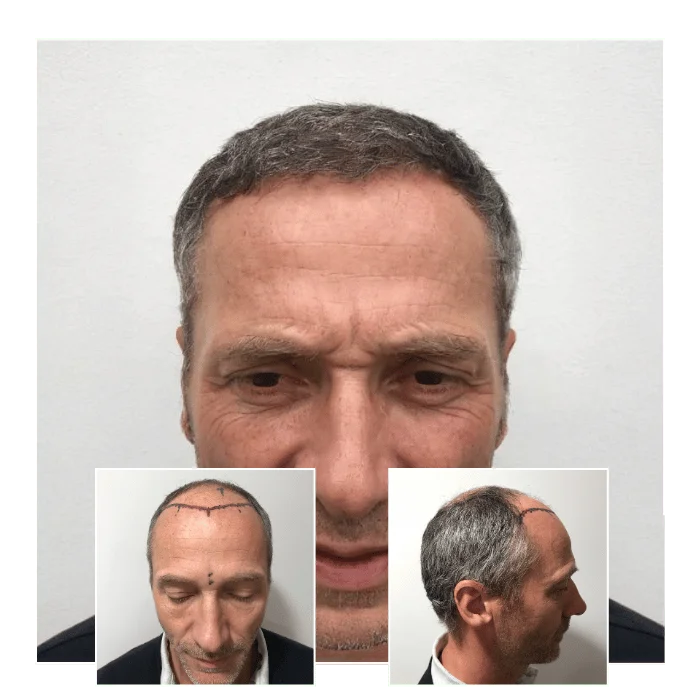 fue hair transplant before and after 02