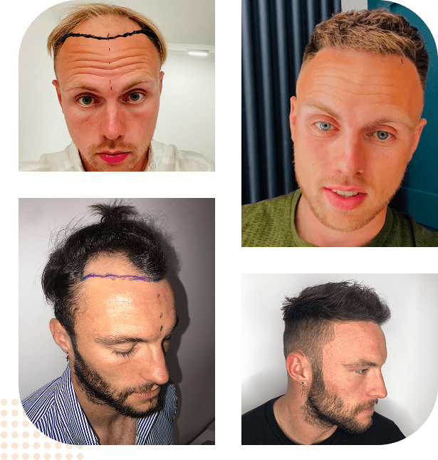 group before after hair transplant portsmouth 01