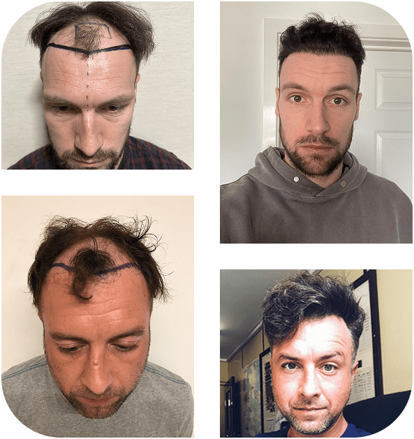 group before after hair transplant portsmouth 02