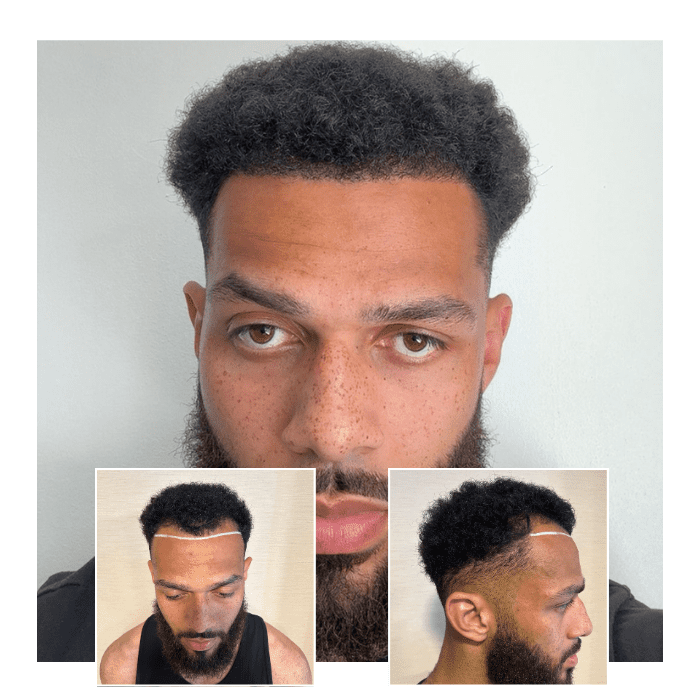 Before After Hair Transplant Guildford 10
