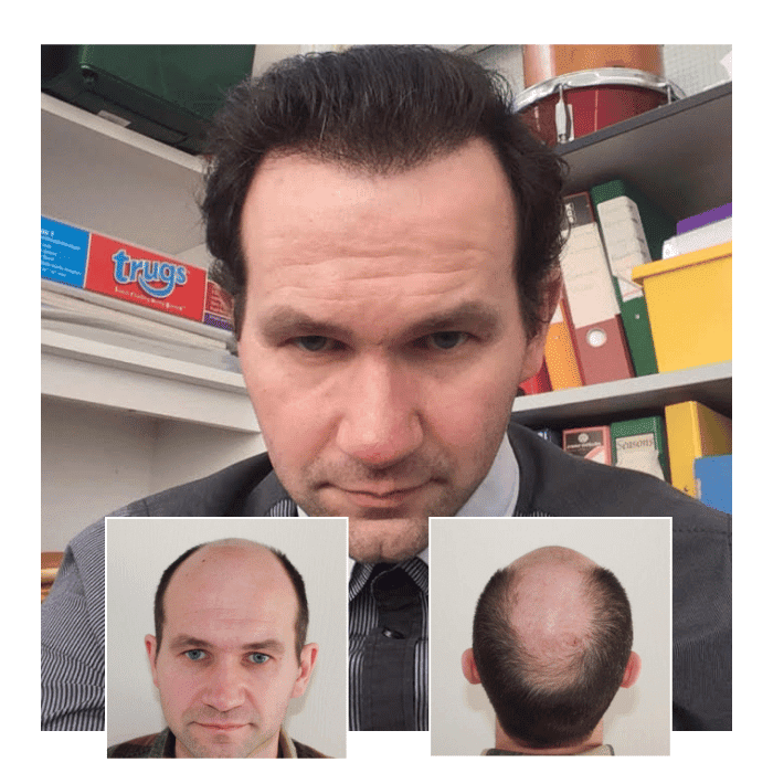 before after hair transplant bromley 07