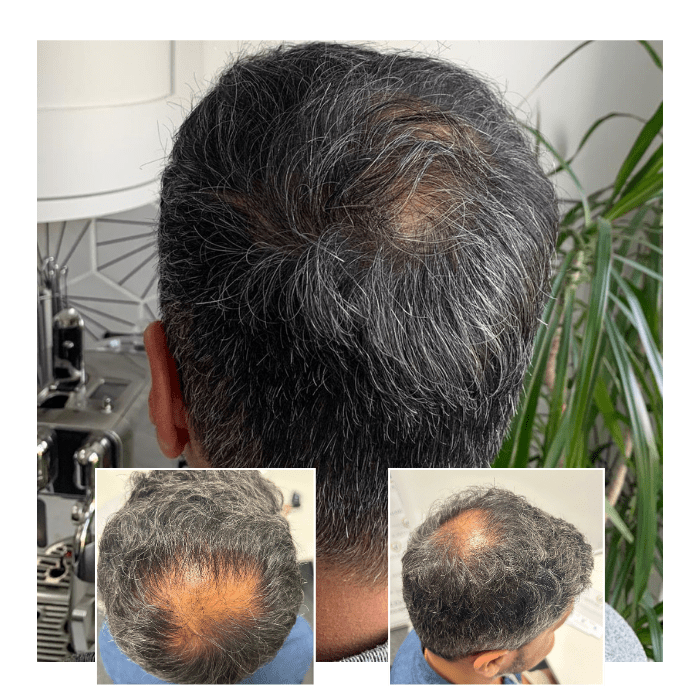 before after hair transplant southampton 01