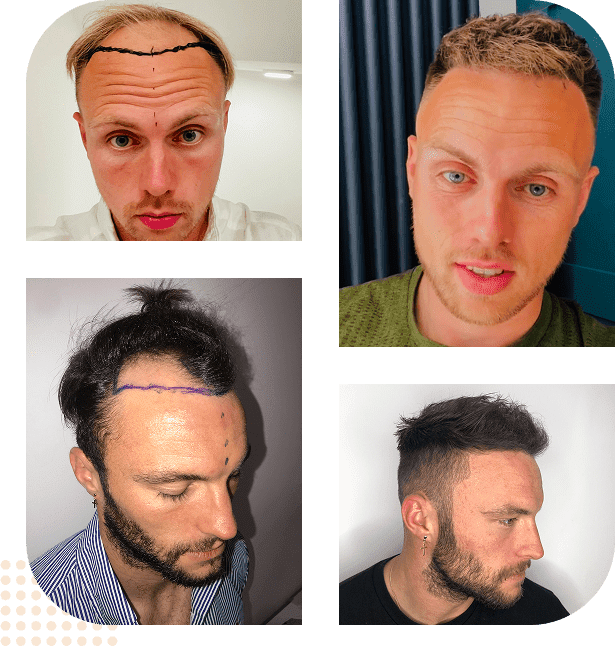 group before after hair transplant bromley 01