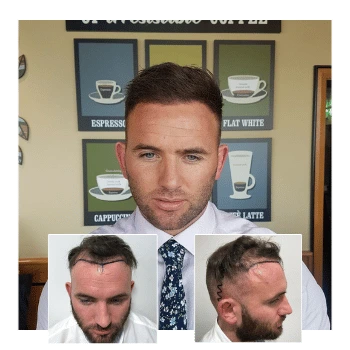 Hair transplant before-and-after comparison showing a man’s restored hairline and temples following successful treatment