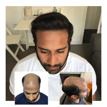 Before-and-after collage of a man with advanced hair loss who achieved a full head of hair following a successful hair transplant