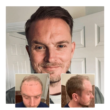 Hair transplant transformation showing restored natural hairline, with before images featuring hairline design markings