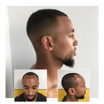 Side and front views of a successful afro hair transplant showing restored hairline, with pre-treatment surgical markings