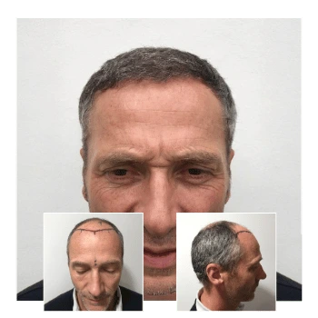 Hair transplant results on a mature male showing restored natural hairline, with pre-treatment planning images