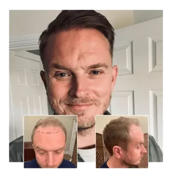 before after hair transplant guildford 03