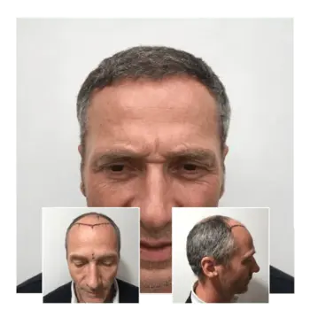 before after hair transplant guildford 04