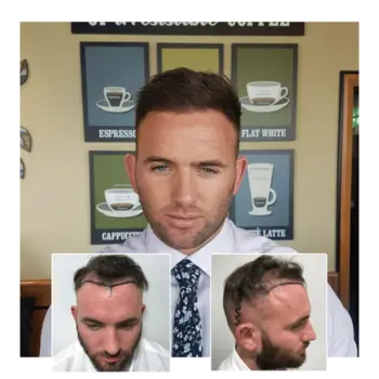 before after hair transplant guildford 05 (1)
