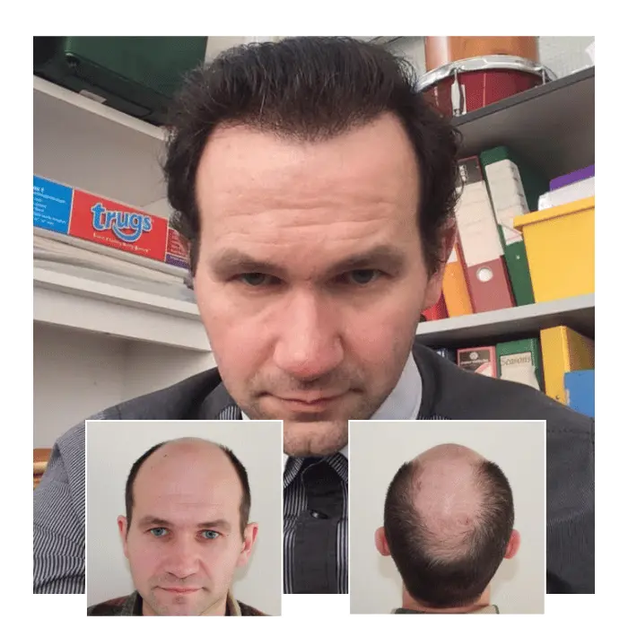 before after hair transplant guildford 07