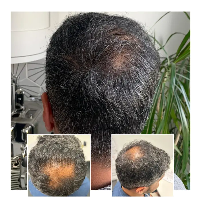 before after hair transplant guildford 09