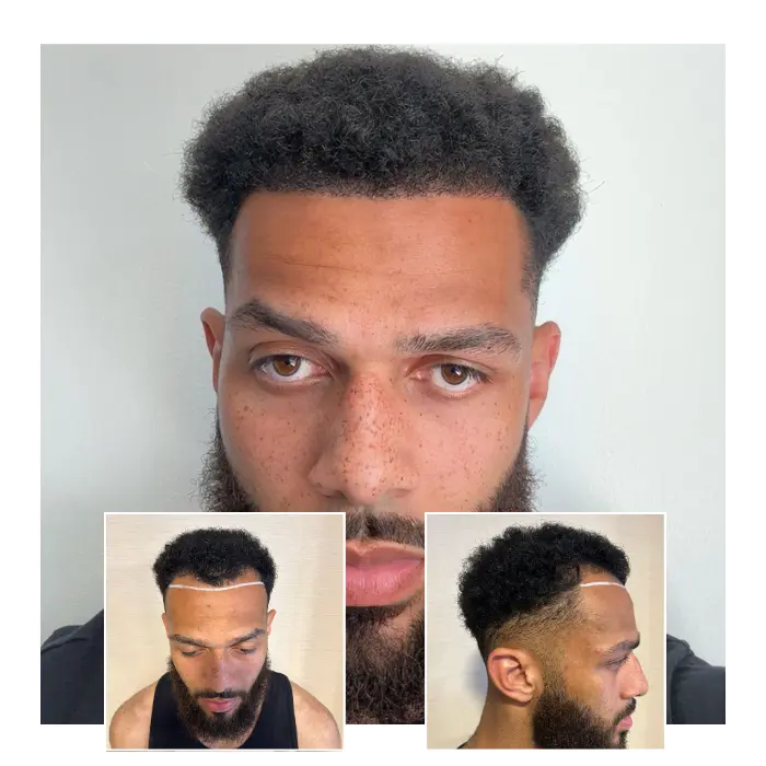 before after hair transplant guildford 10