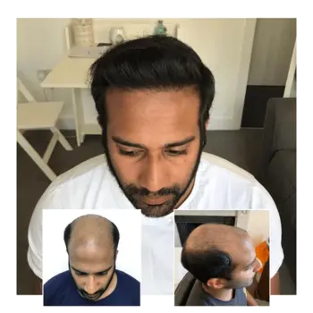 before after hair transplant ipswich suffolk 02