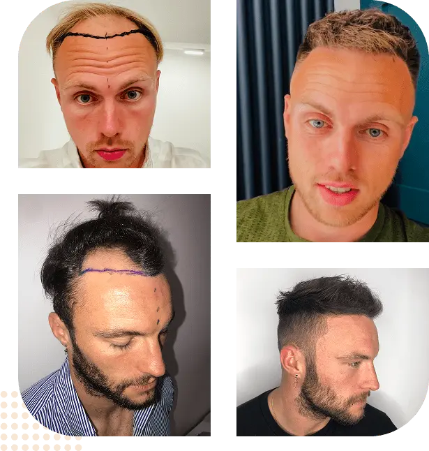 group before after hair transplant guildford 01