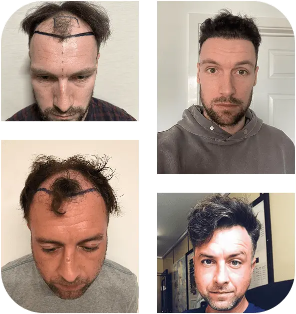 group before after hair transplant guildford 02