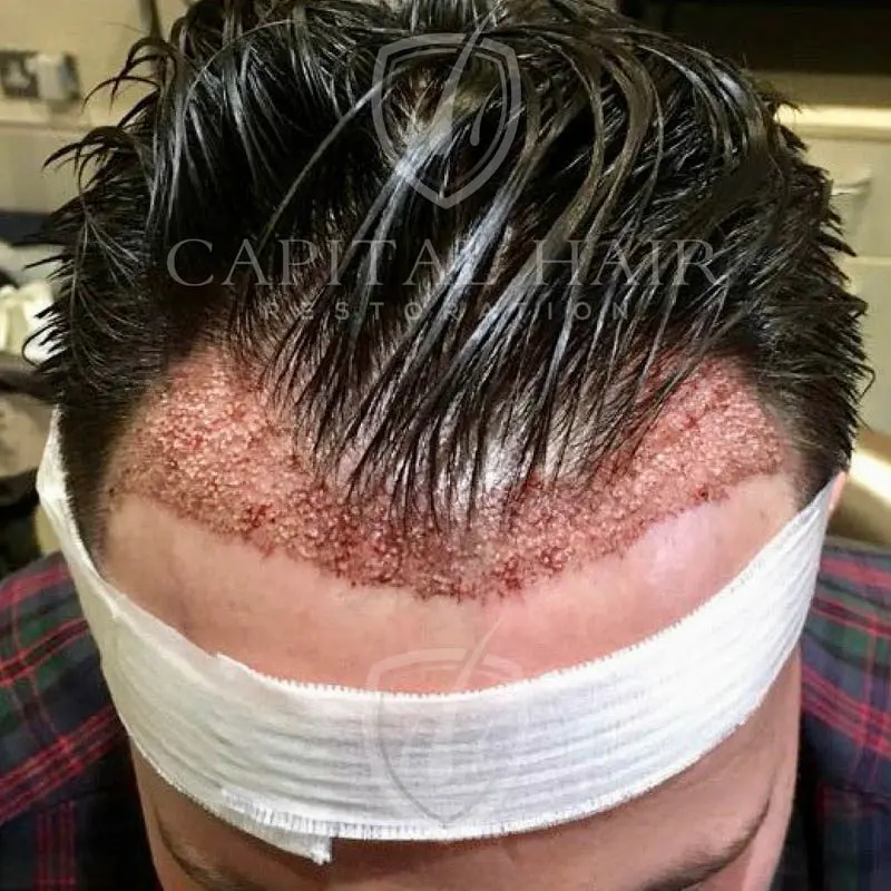 FUE hair transplant results day 1