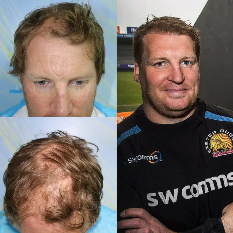 Hair Transplant Near Me Thomas Waldrom