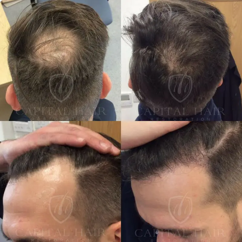 Hair Transplant Before and After Jason