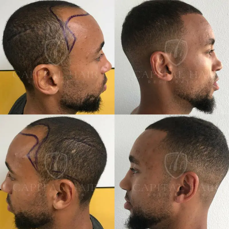 FUE Hair Transplant Before and After Luke Results UK