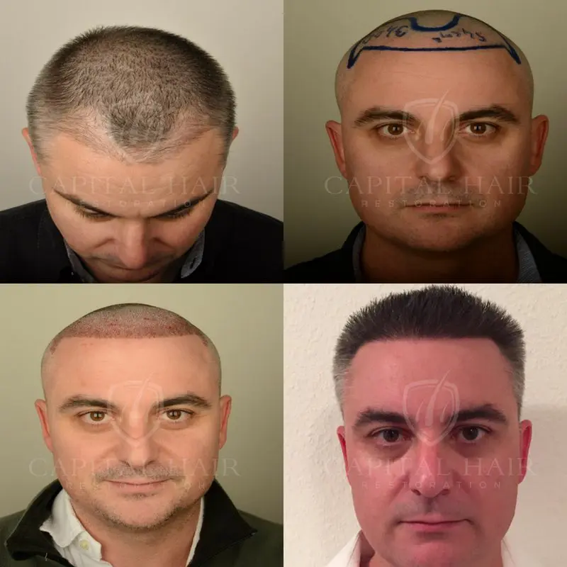 FUE Hair Transplant Before and After Michael Results UK
