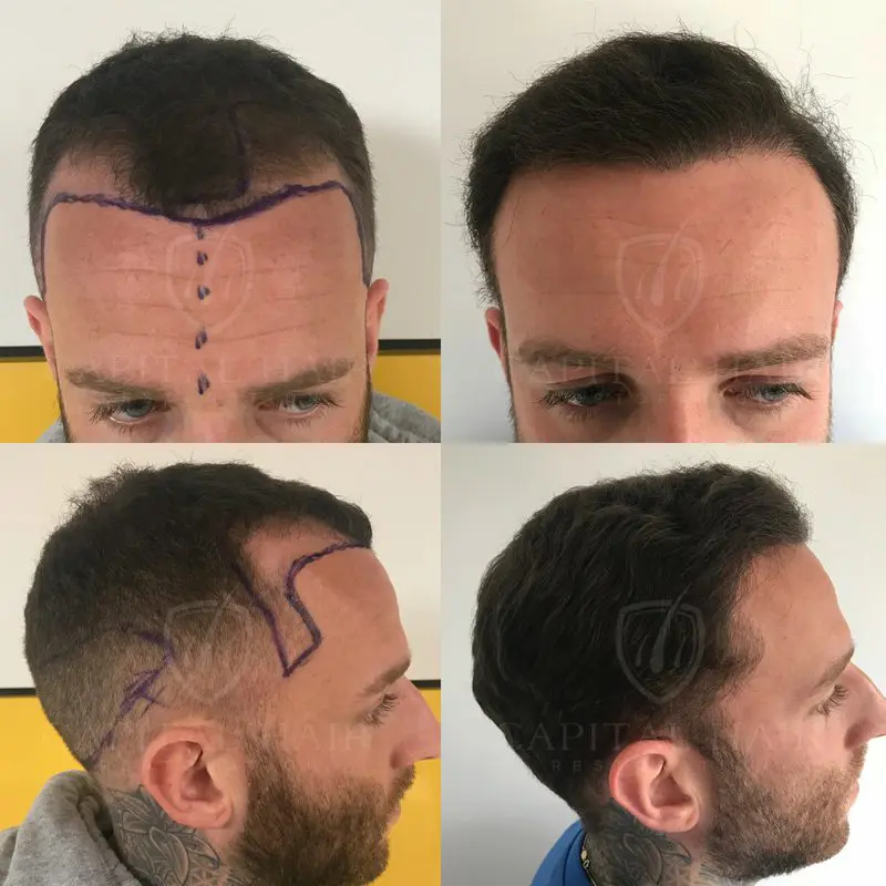 FUE Hair Transplant Graig Results UK