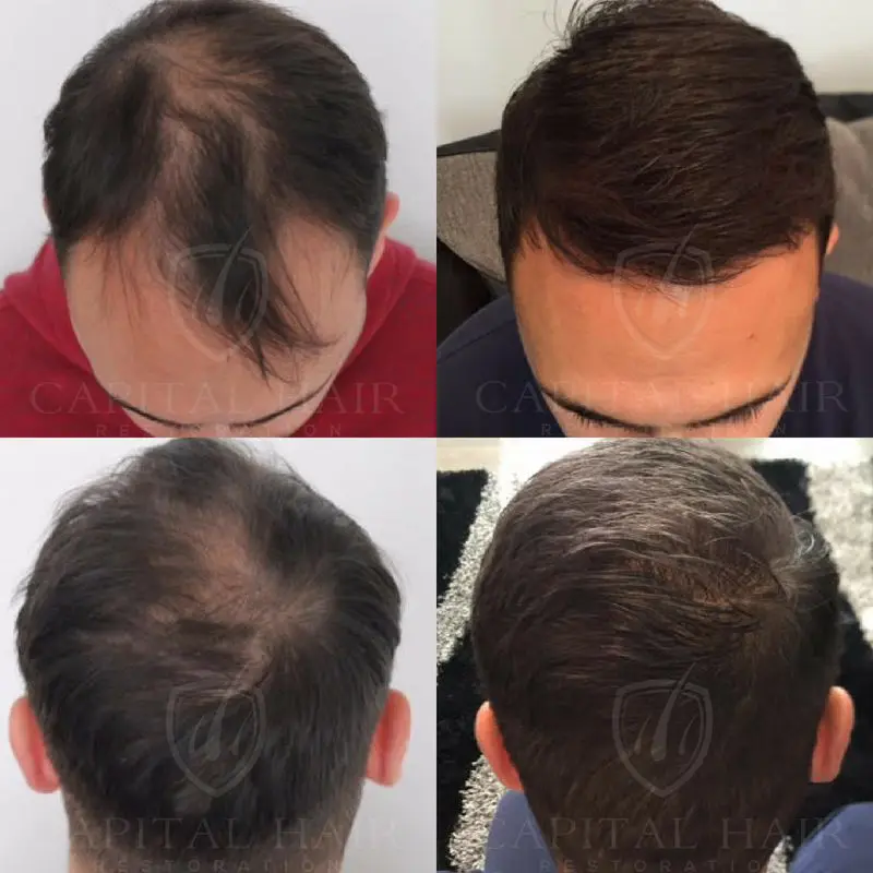 Hair Transplant Before and After Simon Results UK