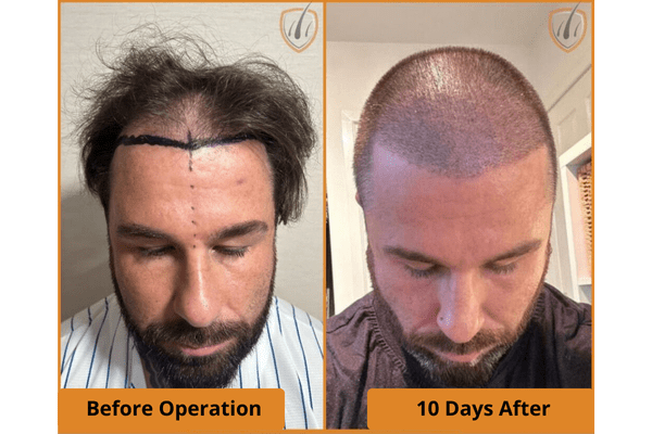 Side-by-side images showing a man before hair transplant surgery with hairline markings and 10 days after with shaved head and new grafts