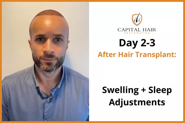 Man shown 2 to 3 days after hair transplant surgery with mild swelling, adjusting sleep position