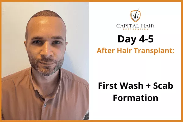 Man shown 4 to 5 days after hair transplant, marking the first wash and scab formation stage