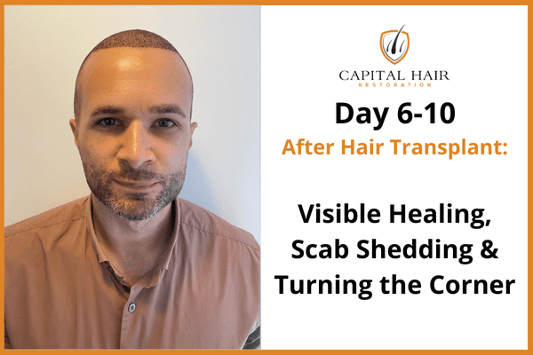 Man shown 6 to 10 days post-hair transplant with visible healing and scalp markings