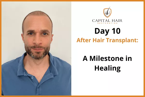 Man with short hair and beard shown 10 days after hair transplant surgery, healing well