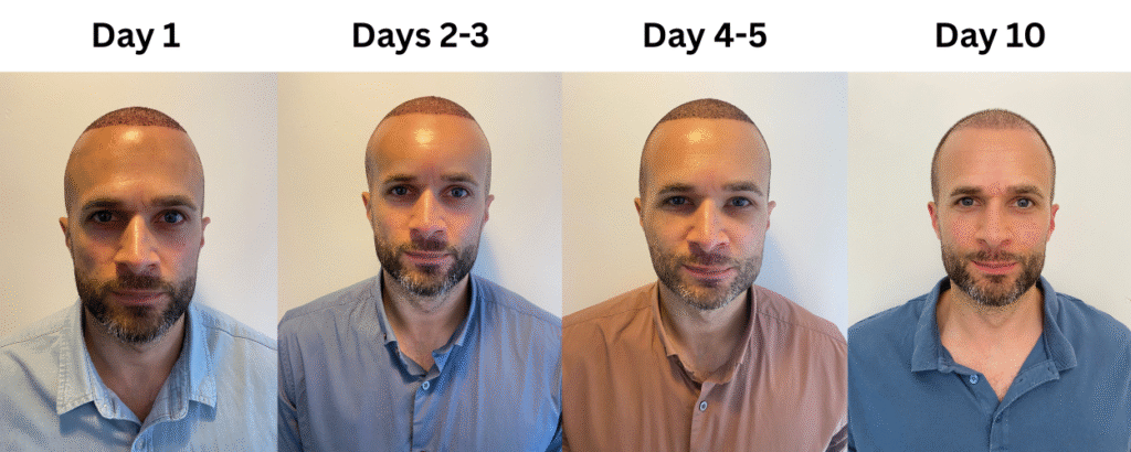 10 days after the hair transplant,hair tranplant