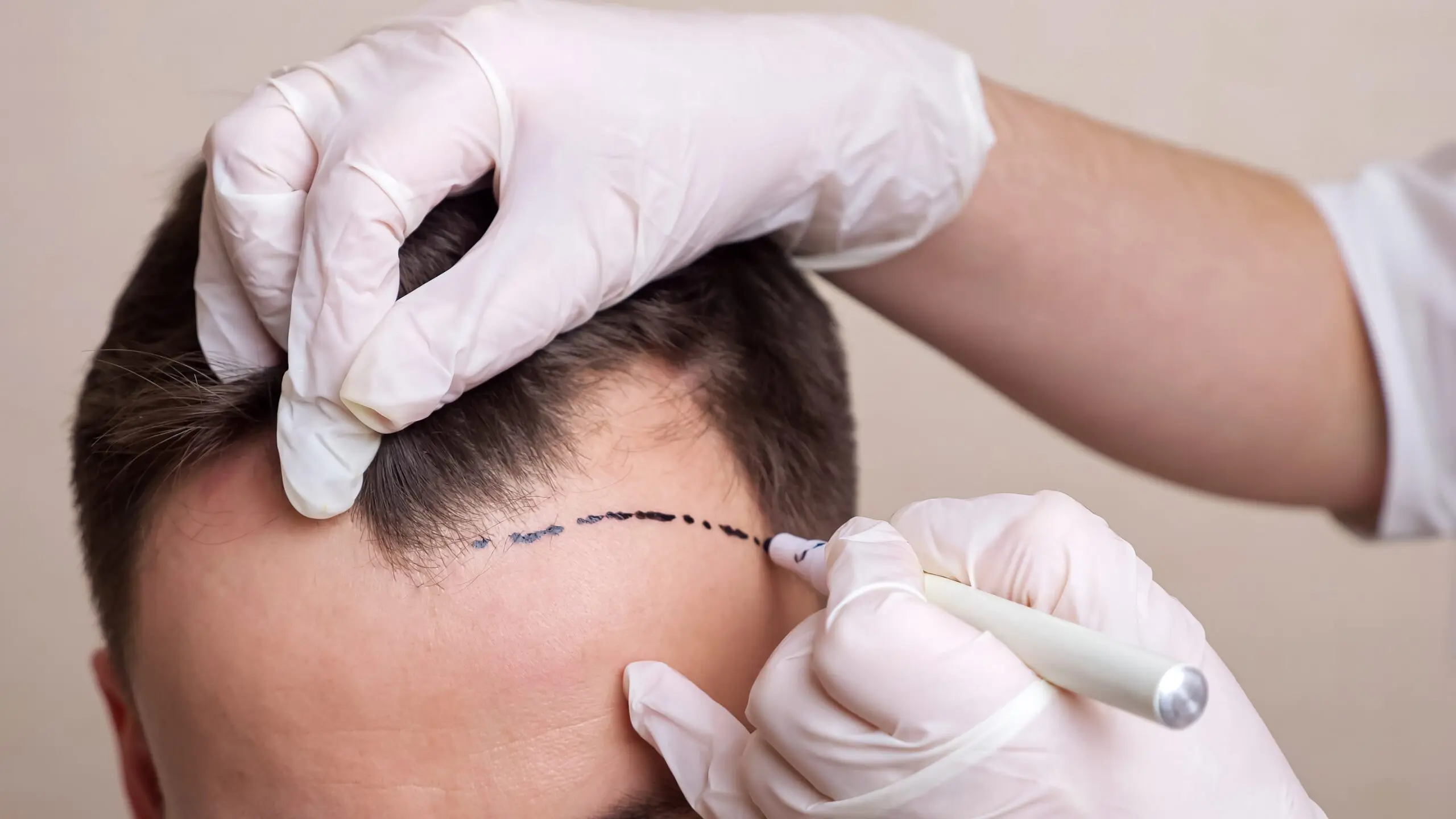 Reduce pain after hair transplant surgery