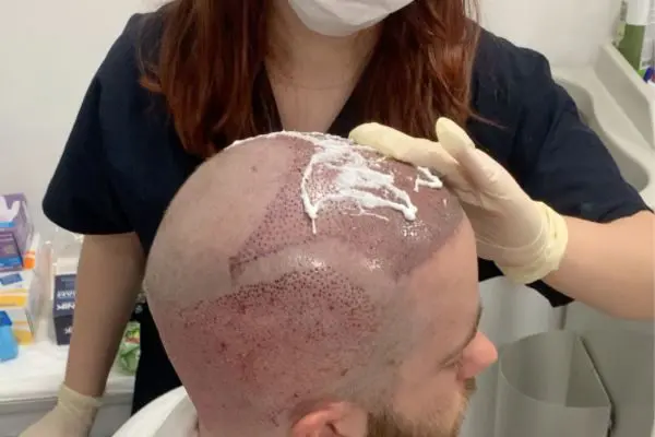 Hair Transplant Turkey from UK