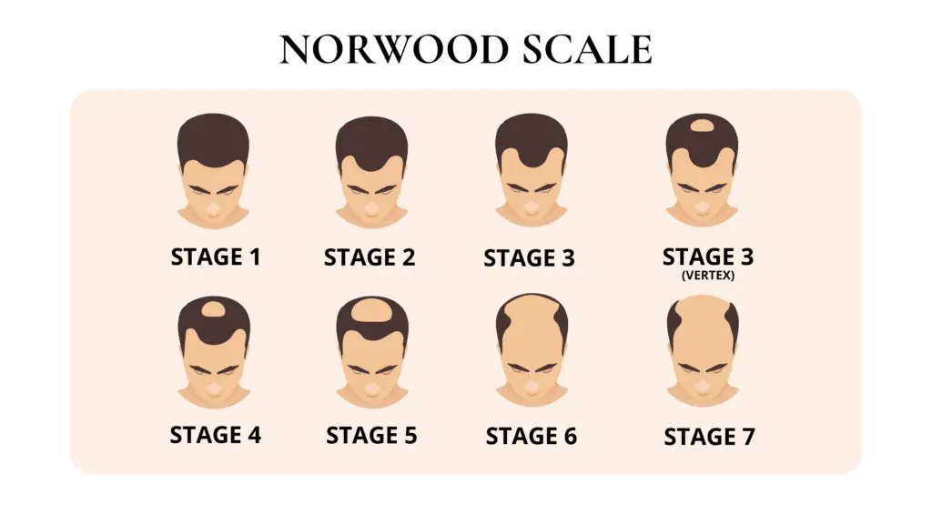 Diagram of the Norwood Scale with eight male head illustrations labeled Stage 1 through Stage 7, including a separate Stage 3 vertex, showing the progression of male pattern baldness from minimal to severe hair loss.