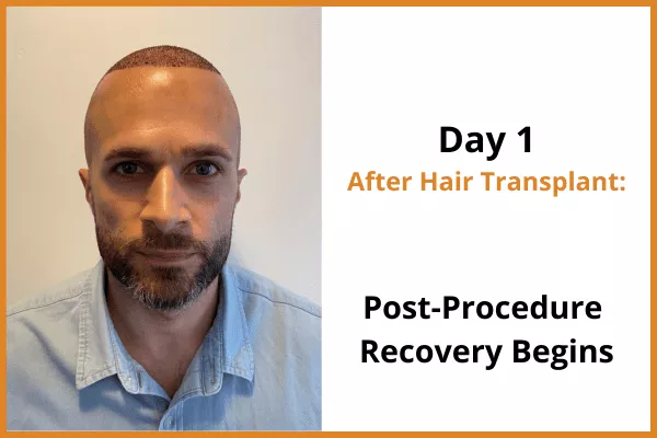 Man shown on day 1 after hair transplant surgery with closely shaved hair and beard, starting recovery